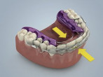 Soft Tissue Management for Traditional and Digital Restorations Webinar Thumbnail