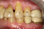 Figure  11  Class A RSBI on the lingual aspects of teeth Nos. 10, 11, and 12. The facial aspect of No. 12 represents a Class B RSBI (Figure 13). Note adequate soft tissue support at the CEJ.