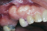 Figure  10  Multiple exostoses can be seen on the maxillary right premolar and molar region.