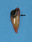 Figure  21  Extracted tooth No 13. Note the recurrent caries under the large amalgam restoration (white arrow) that extends beyond the CEJ (black arrow).