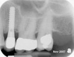 Figure  26  The 8-month post-loading radiograph.