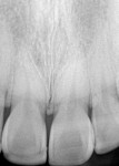 Figure  15 Postoperative radiograph of the patient’s restorations.