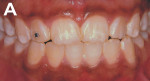 Figure 1   A 17-year-old girl with white enamel stain of hard texture, located just on dental enamel in the superior and inferior teeth.