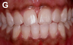 Figure 7  After enamel microabrasion and dental bleaching.