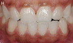 Figure 8  Three years after enamel microabrasion and dental bleaching.
