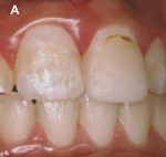 Figure 9: A 16 year-old girl with white enamel stain of hard texture, color alterations, and surface irregularities on the buccal aspect of the maxillary right central incisor, and a composite resin restoration on the buccal aspect of the maxillary left c