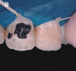 Figure 10  Immediately after application of a fine-tapered diamond bur No. 3195 FF and during the application of enamel microabrasive Opalustre for 1 minute, in each application of compound.