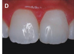 Figure 12  Immediately after enamel microabrasion, dental bleaching, and the restoration using bonding system with composite resin Opallis.
