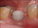 Zirconia Fracturing Prevention: A Scientific Perspective Webinar Thumbnail