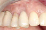 Figure 11  One-year follow-up of final restoration shows maintenance of papillae and facial gingival form. This is significant considering the thin scalloped nature of the gingival tissue.