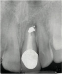 Figure 13  Periapical pathology on tooth No. 9.