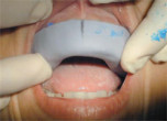 Soft Tissue Management in the Presence of Peri-Implant Diseases Webinar Thumbnail
