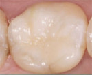 Current Trends and New Beginnings for Retaining Restorations on Dental Implants Webinar Thumbnail