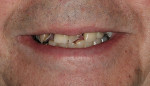 Figure 1  Low lip line smile at presentation.