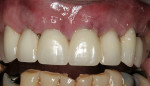 Figure 9: Day of surgery and insertion of provisional restoration (Nos. 6 through 12) by the restorative dentist immediately postsurgery.