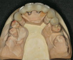 Figure 17  Final case after porcelain has been baked onto the zirconia on the lab model. Individual crowns were made for Nos. 6, 11, and 12 and a splinted implant bridge for Nos. 7 through 10.
