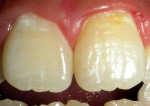 Figure 2  Extrinsic pigmentation observed after the application of 4% TiF4 on the left superior incisor, in the first-month review consultation after prophylaxis.