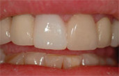 Treatment Solutions Simplified with a New and Innovative Internal Hex Implant Webinar Thumbnail