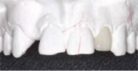 The Dental Handpieces Conundrum Webinar Thumbnail