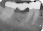 Figure 1  Preoperative PA demonstrating 3-unit bridge, taken by patient’s restorative dentist.