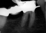 Figure 4  Radiograph taken to determine if entire piece of drill was removed from the canal.