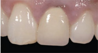 Unleashing the Power of Guided Endodontics Webinar Thumbnail