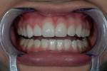 Figure 15  Prepless veneers tried in on right side next to prototypes on left side