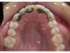 Fig 9. A semi-rigid synthetic barrier was inserted in a subperiosteal manner where a significant loss of palatal bone and thin buccal plate existed.
