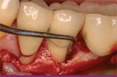 Essential Elements to Gain the Advantages of Digital Technology in Implant Dentistry Webinar Thumbnail