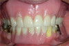 Fig 4. Intraoral frontal view before treatment.