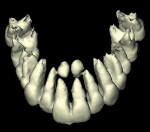 Figure 10  Supernumerary teeth (mesiodens), anterior maxilla, 3-D reformation.