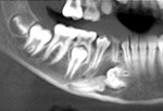 Figure 13  Complex odontoma, mandibular right, preoperative panorex, and 3-D CT scan reformation