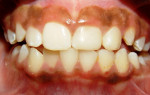 Figure 6  Intraoral view after definite filling of the root canals.