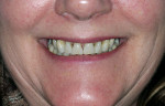 Figure 2  Close-up preoperative view; note the lack of interdental papillae and resulting 