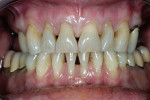 Figure 3  Retracted preoperative view showing triangular shaped teeth, which contribute to the esthetic challenge.