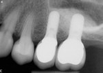 Figure 18  Post-cementation radiographs; note the ideal implant position directly beneath the crowns and sinus augmentation.