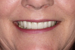 Figure 20  Final postoperative photographs demonstrate successful esthetic results.