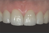Utilizing “All Tissue Laser” Technology in the Management of Periodontal and Implant Disease Webinar Thumbnail