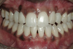 Figure 9: Retracted smile view of the provisionals. The cuspids are cantilevered off the lateral incisors.