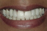 Figure 11  Post-treatment smile reveals natural-looking gingival tissue, as well as implants, in the location of the cuspids and porcelain veneers on the lateral incisors.