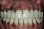 Figure 12  Post-treatment retracted smile reveals natural-looking gingival tissue and implants in the location of the cuspids and porcelain veneers on the lateral incisors.