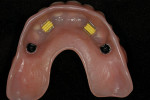 Figure 12  Upper and lower implant-borne prostheses.