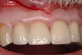 Removable Implant Solutions for the Edentulous Patient Webinar Thumbnail