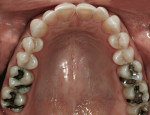 Figure 5  Severe erosion was evident on lingual surfaces of maxillary incisors.