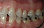 Figure 8  Diastema between tooth Nos. 22 and 23 was a major concern for the patient.
