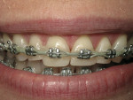 Figure 10  Transitional bonding placed on the maxillary incisors to provisionally restore length and contour.