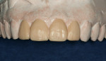 Figure 12  Diagnostic wax-up was done to guide the preparation and provisional phase.