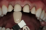 Figure 13  Conservative preparations were done to maximize esthetics and bond strength.