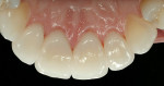 Figure 15  Lingual surfaces of final crowns showing restoration of palatal contours.