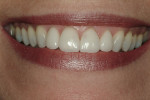 Figure 16  Note the correction of gingival and tooth shape discrepancies in incisor crowns.